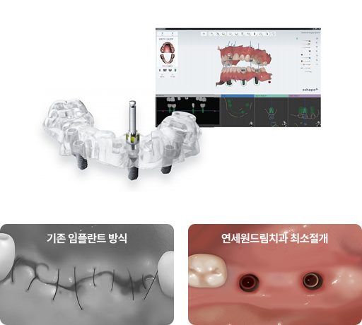네비게이션 임플란트