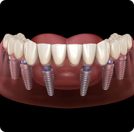전악(전체) 임플란트