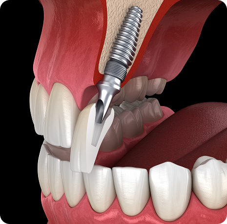 고난도 임플란트