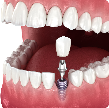 임플란트 재수술