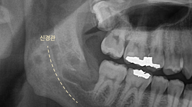 사랑니 발치 후01