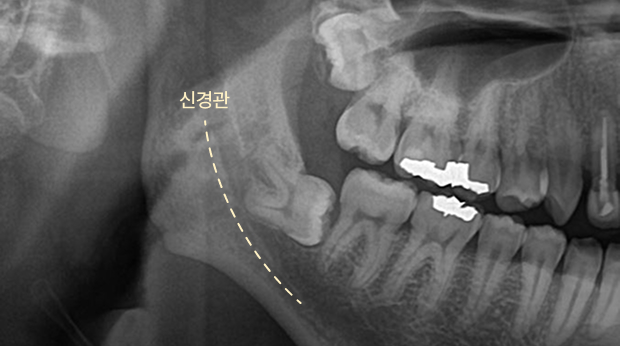 사랑니 발치 전01